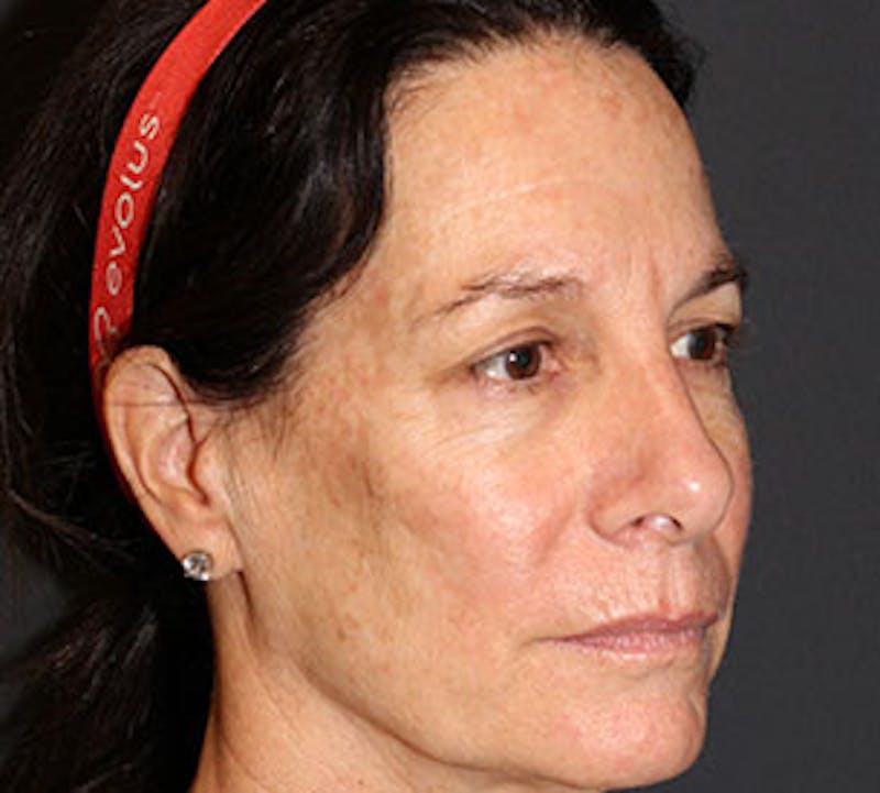 Browlift/Upper Blepharoplasty Before & After Gallery - Patient 117645746 - Image 3
