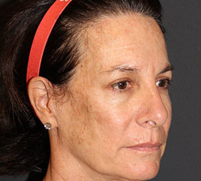 Browlift/Upper Blepharoplasty Before & After Gallery - Patient 117645746 - Image 4