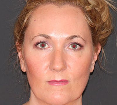 Browlift/Upper Blepharoplasty Before & After Gallery - Patient 117645747 - Image 2