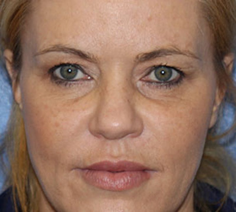 Browlift/Upper Blepharoplasty Before & After Gallery - Patient 117645748 - Image 1