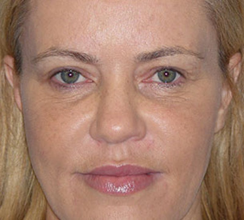 Browlift/Upper Blepharoplasty Before & After Gallery - Patient 117645748 - Image 2