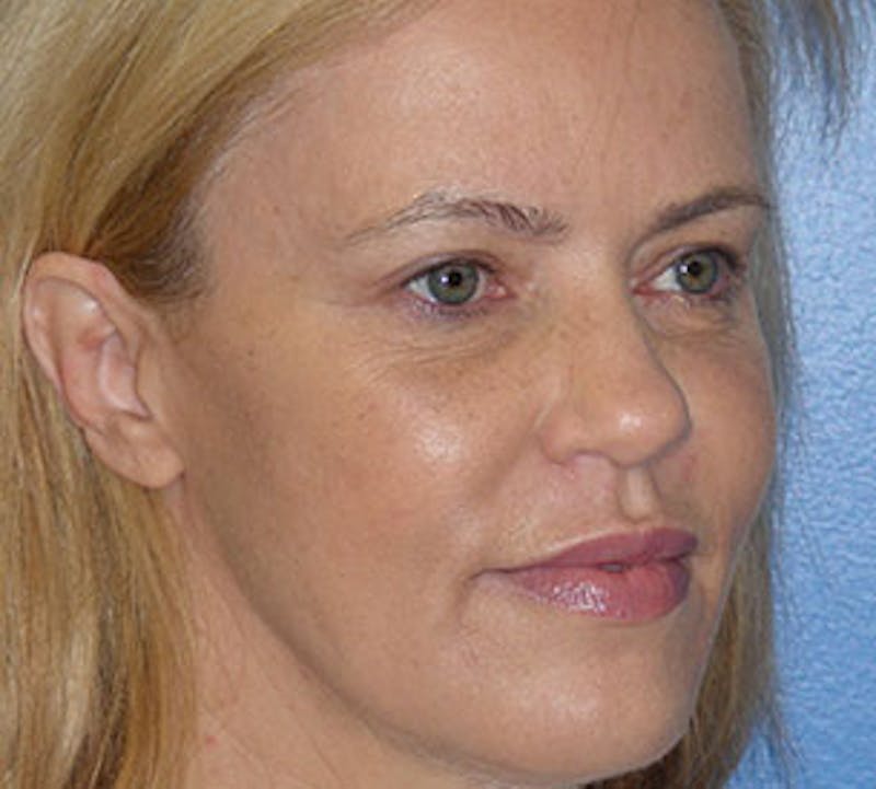 Browlift/Upper Blepharoplasty Before & After Gallery - Patient 117645748 - Image 4