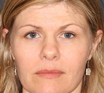 Browlift/Upper Blepharoplasty Before & After Gallery - Patient 117645752 - Image 1