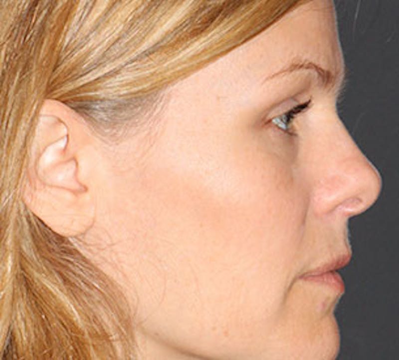 Browlift/Upper Blepharoplasty Before & After Gallery - Patient 117645752 - Image 8