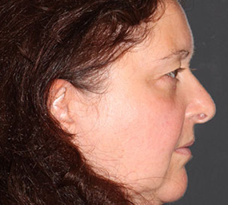 Browlift/Upper Blepharoplasty Before & After Gallery - Patient 117645753 - Image 7