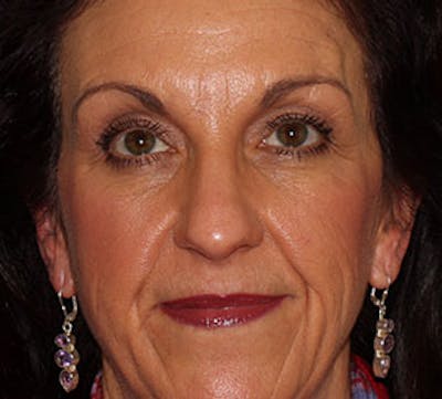Browlift/Upper Blepharoplasty Before & After Gallery - Patient 117645754 - Image 1