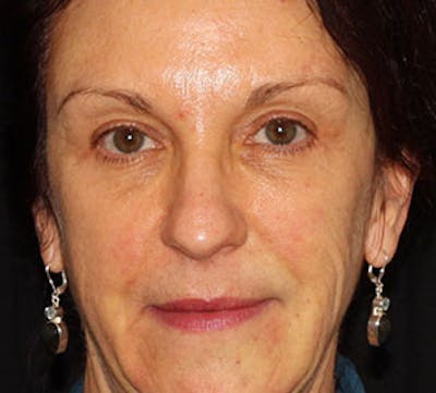 Browlift/Upper Blepharoplasty Before & After Gallery - Patient 117645754 - Image 2