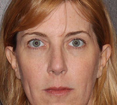 Browlift/Upper Blepharoplasty Before & After Gallery - Patient 117645755 - Image 1