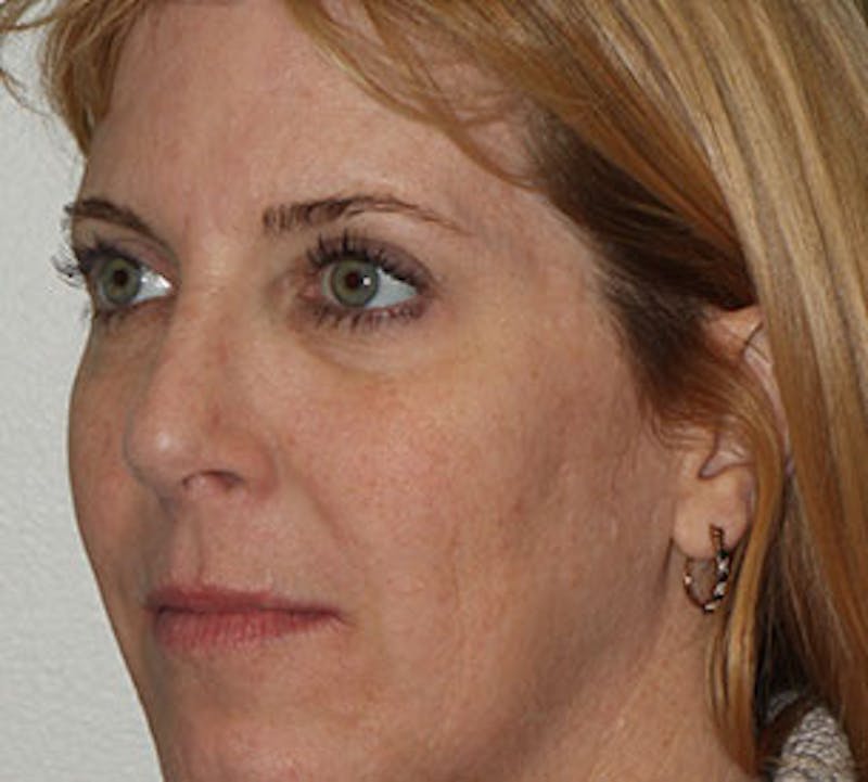 Browlift/Upper Blepharoplasty Before & After Gallery - Patient 117645755 - Image 6