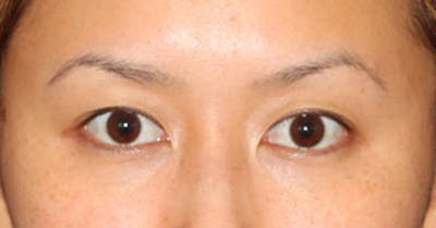 Asian (Double) Eyelid Before & After Gallery - Patient 117645773 - Image 1