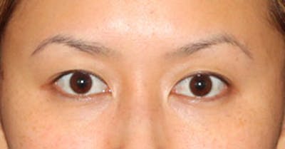 Asian (Double) Eyelid Before & After Gallery - Patient 117645773 - Image 1