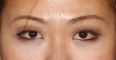 Asian (Double) Eyelid Before & After Gallery - Patient 117645774 - Image 1