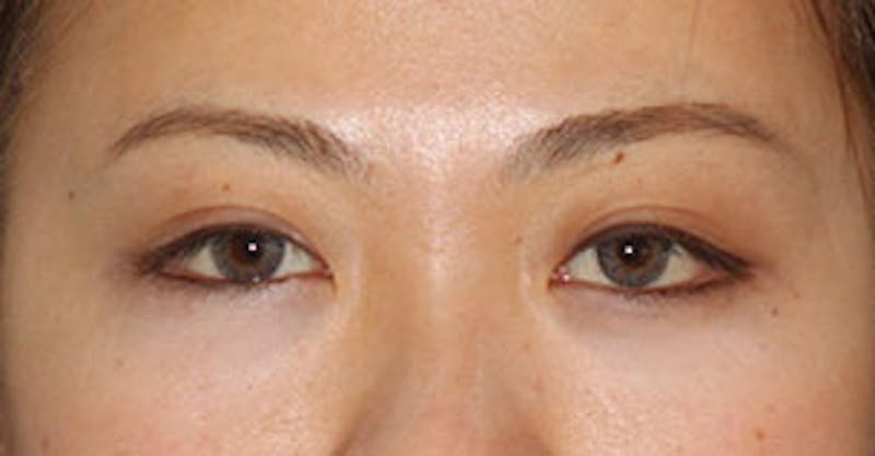 Asian (Double) Eyelid Before & After Gallery - Patient 117645774 - Image 2