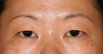Asian (Double) Eyelid Before & After Gallery - Patient 117645776 - Image 1