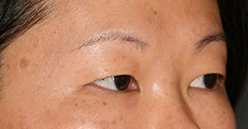 Asian (Double) Eyelid Before & After Gallery - Patient 117645776 - Image 3
