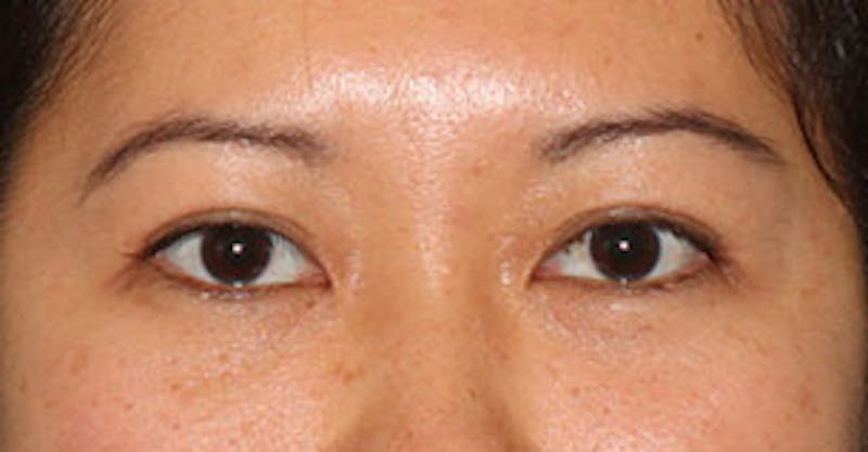 Asian (Double) Eyelid Before & After Gallery - Patient 117645777 - Image 2