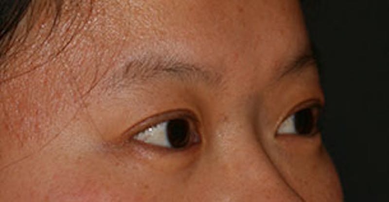 Asian (Double) Eyelid Before & After Gallery - Patient 117645778 - Image 4