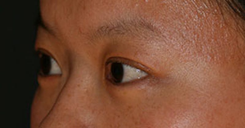 Asian (Double) Eyelid Before & After Gallery - Patient 117645778 - Image 6