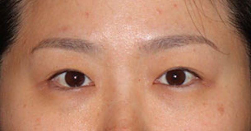 Asian (Double) Eyelid Before & After Gallery - Patient 117645779 - Image 1
