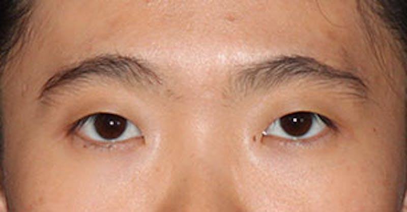 Asian (Double) Eyelid