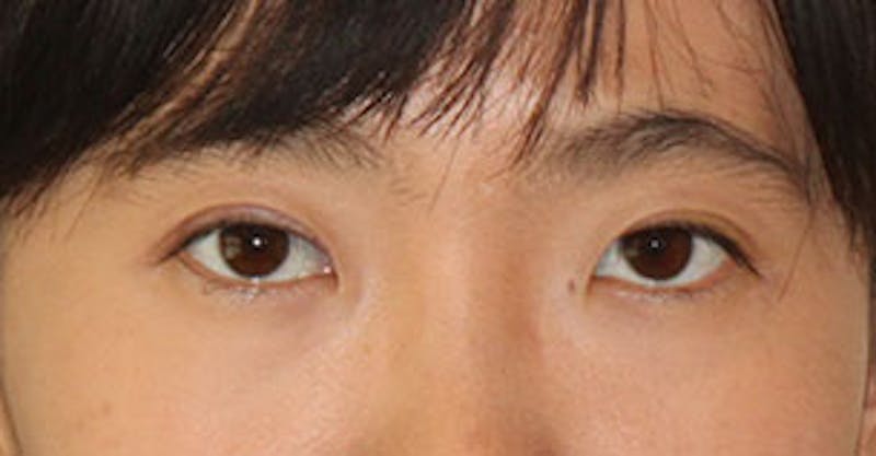 Asian (Double) Eyelid