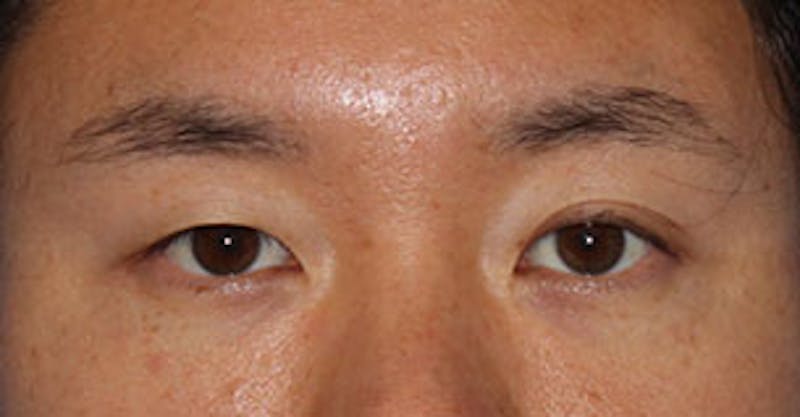 Asian (Double) Eyelid Before & After Gallery - Patient 117645781 - Image 1