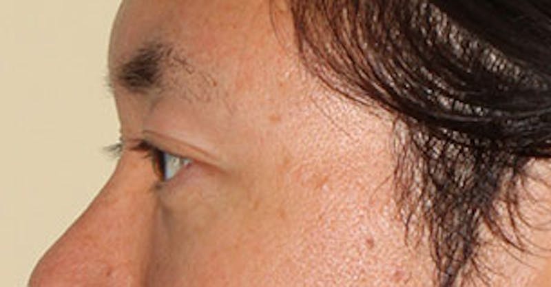 Asian (Double) Eyelid Before & After Gallery - Patient 117645781 - Image 10