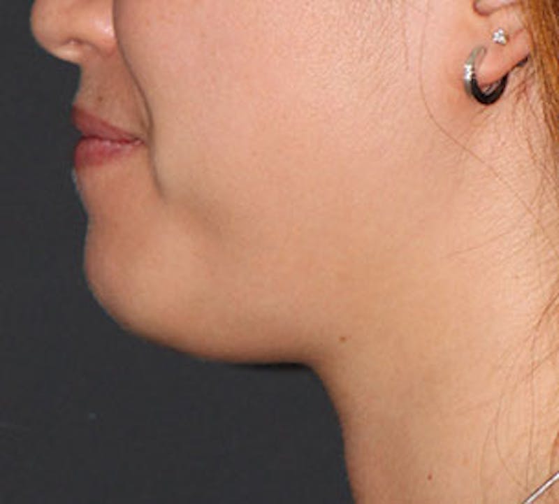 Neck Liposuction Before & After Gallery - Patient 117645783 - Image 9
