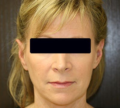 Otoplasty Before & After Gallery - Patient 117645789 - Image 2