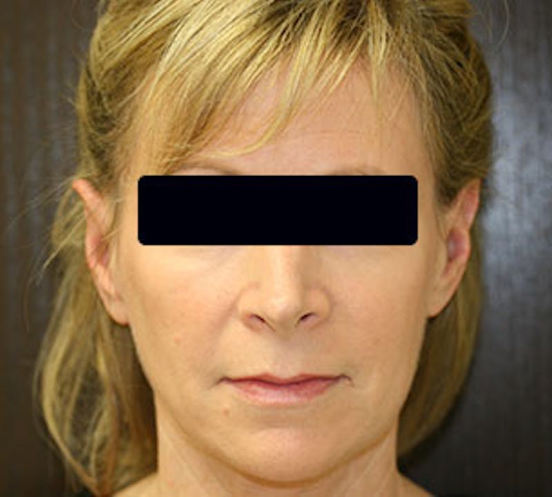 Otoplasty Before & After Gallery - Patient 117645789 - Image 2