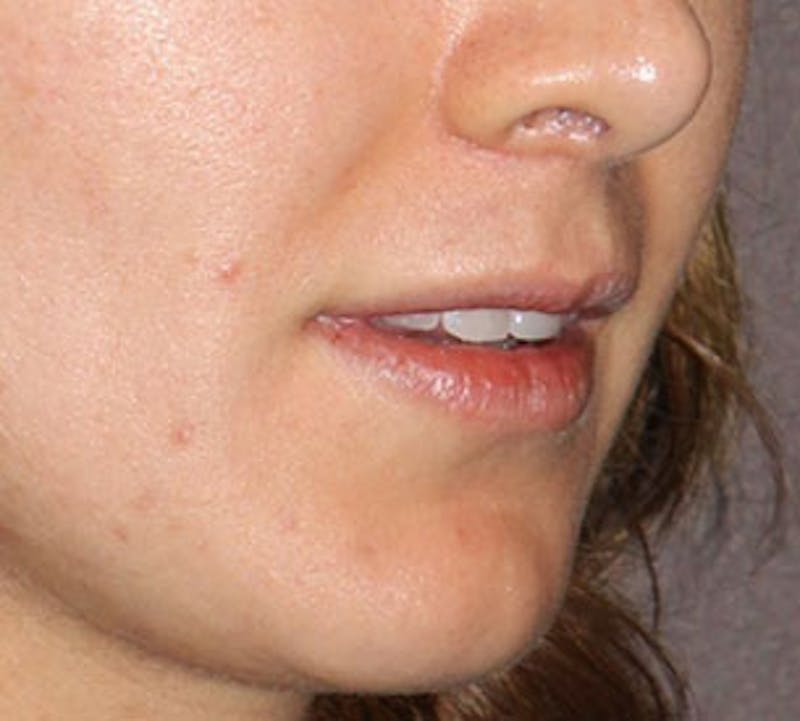 Lip Enhancement Before & After Gallery - Patient 117645791 - Image 5