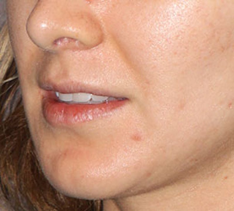 Lip Enhancement Before & After Gallery - Patient 117645791 - Image 7