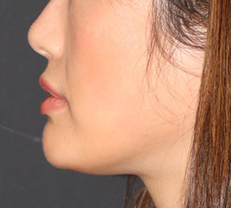 Lip Enhancement Before & After Gallery - Patient 117645792 - Image 10