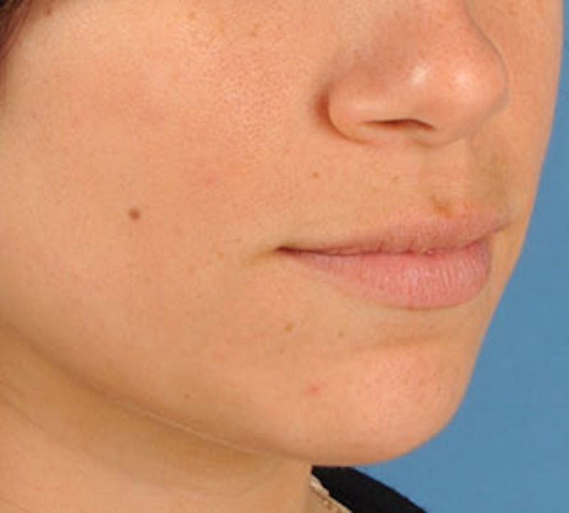 Lip Enhancement Before & After Gallery - Patient 117645793 - Image 5