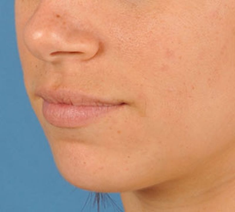 Lip Enhancement Before & After Gallery - Patient 117645793 - Image 7