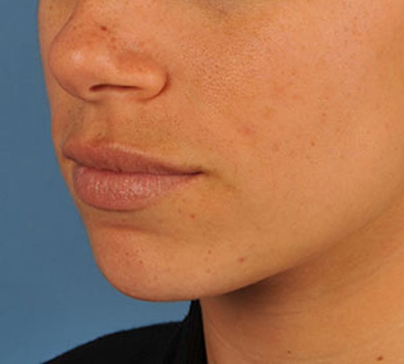 Lip Enhancement Before & After Gallery - Patient 117645793 - Image 8