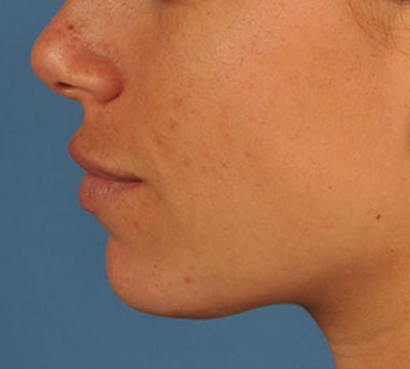 Lip Enhancement Before & After Gallery - Patient 117645793 - Image 12