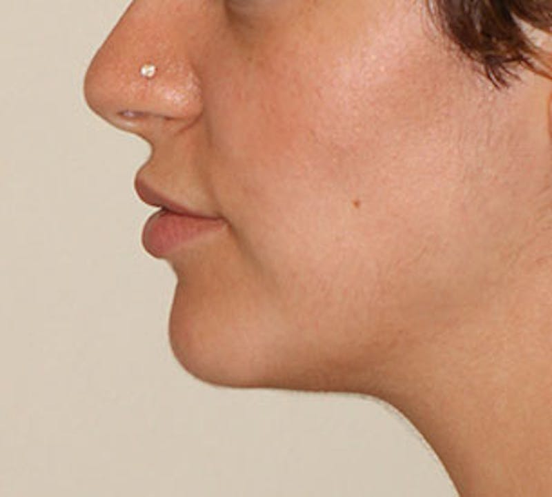 Lip Enhancement Before & After Gallery - Patient 117645795 - Image 11