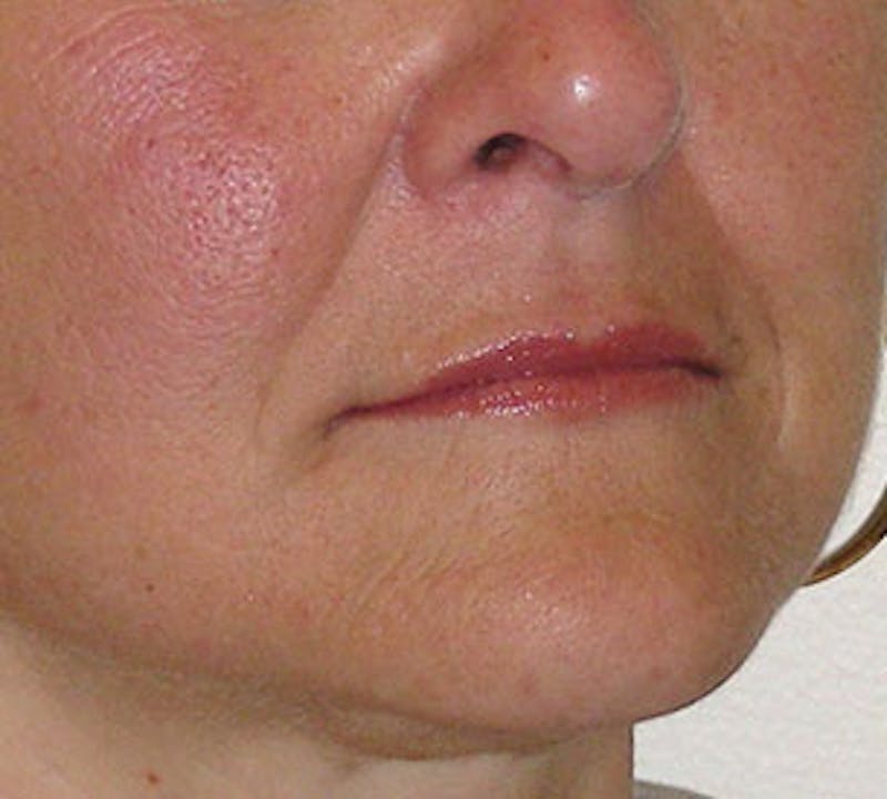 Lip Enhancement Before & After Gallery - Patient 117645796 - Image 6