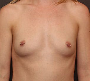 Breast Augmentation