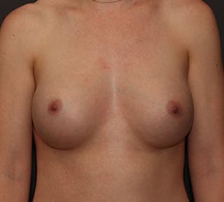 Breast Augmentation Before & After Gallery - Patient 117645802 - Image 2