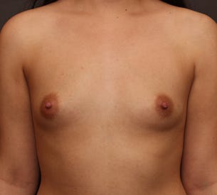 Breast Augmentation