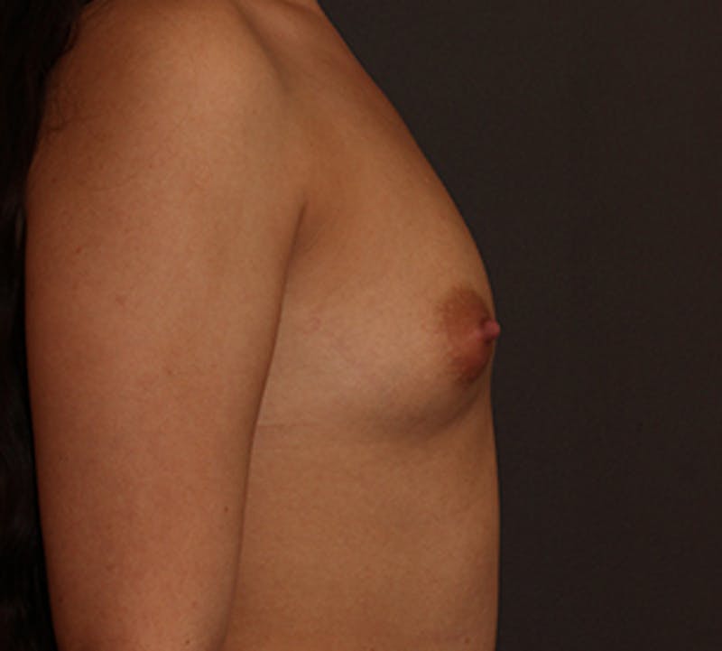 Breast Augmentation Before & After Gallery - Patient 117645803 - Image 7