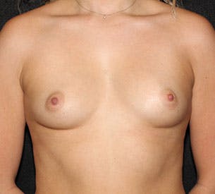 Breast Augmentation