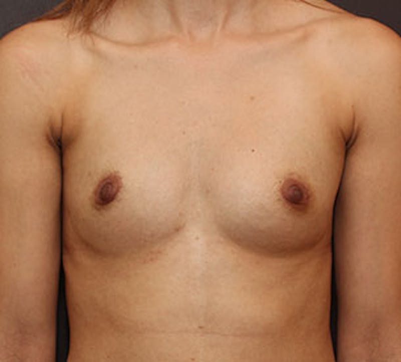 Breast Augmentation Before & After Gallery - Patient 117645810 - Image 1