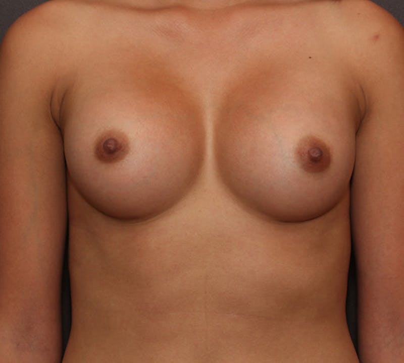 Breast Augmentation Before & After Gallery - Patient 117645812 - Image 2
