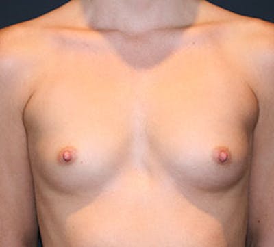 Breast Augmentation Before & After Gallery - Patient 117645815 - Image 1