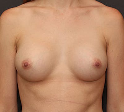 Breast Augmentation Before & After Gallery - Patient 117645820 - Image 2