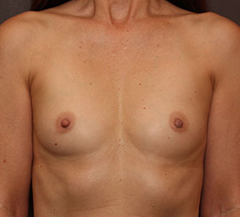Breast Augmentation Before & After Gallery - Patient 117645822 - Image 1