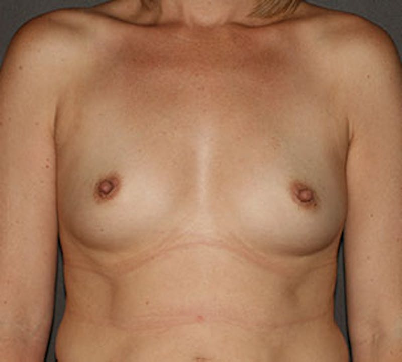 Breast Augmentation Before & After Gallery - Patient 117645823 - Image 1